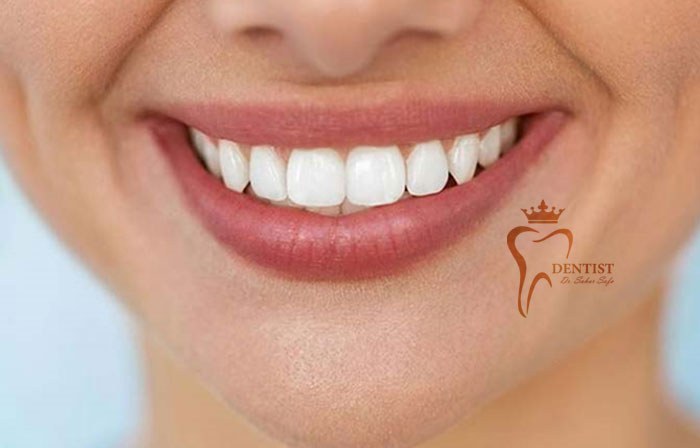 بلیچینگ دندان