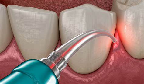 جراحی لثه با لیزر